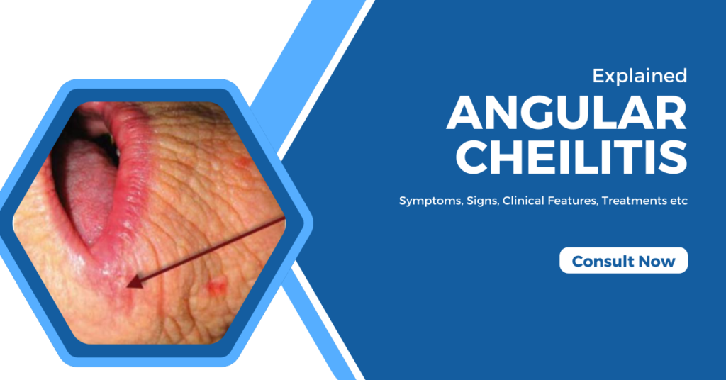 Angular Cheilitis - Diagnosis, Treatments, Clinical Features & More