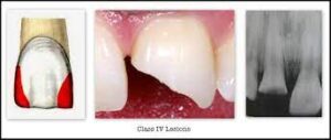 Class 4 caries in GV Black Classification