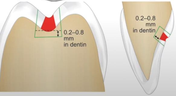 Depth of the cavity in cavity preparation.