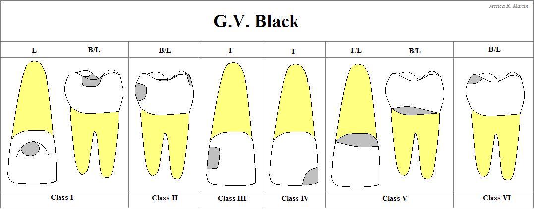 GV Black Classification Chart