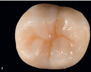 occlusal surface in GV black classification