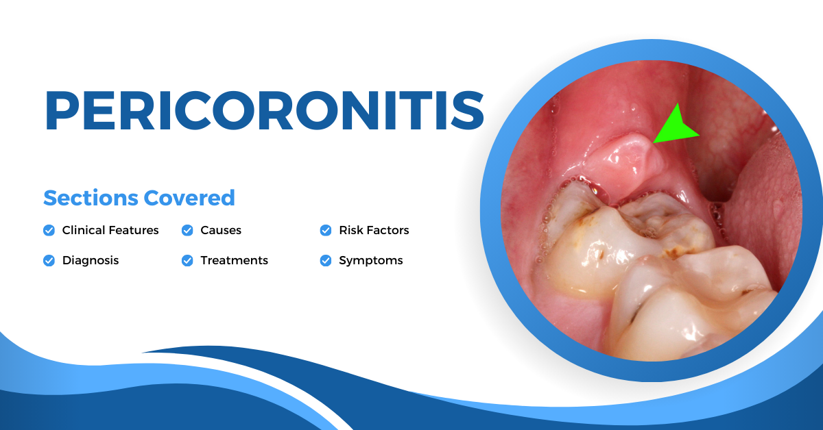 Pericoronitis causes, treatments, symptoms etc