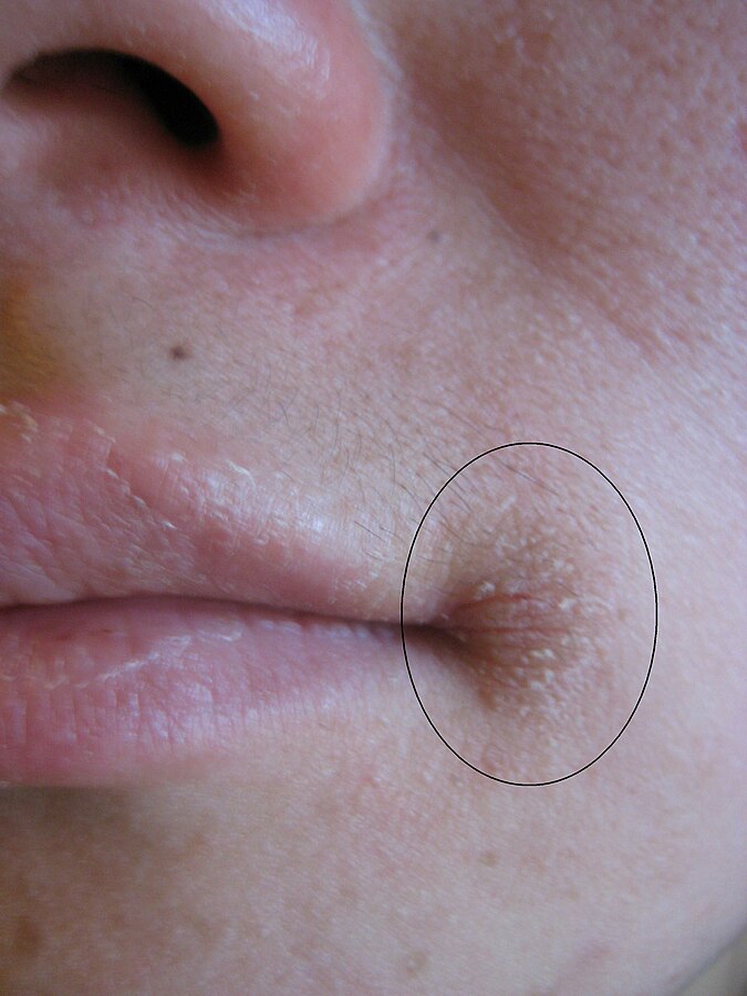Triangular area at the corner of mouth in angular cheilitis.