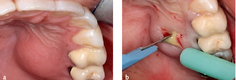 Acute alveolar abscess in single visit endodontics. 