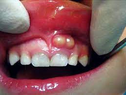 Alveolar abscess in single visit endodontics