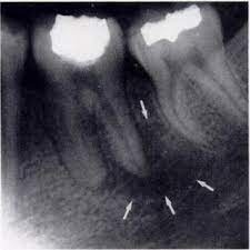 Alveolar abscess in single visit endodontics