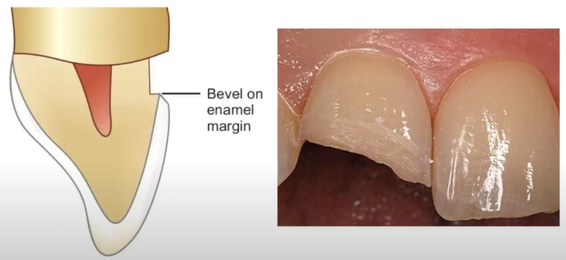 Bevel in composite of cavity preparation.