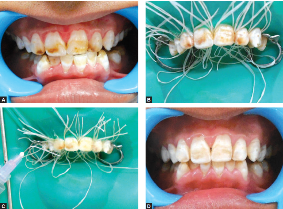 Bleaching before after in Endodontics