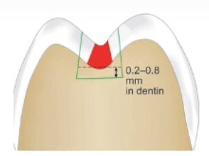 Bulk of the material in cavity preparation.