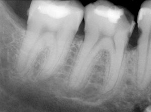 Calcified canal in single visit endodontics