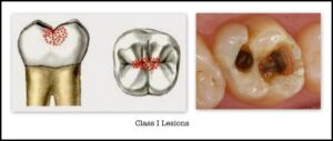 Class 1 caries in GV black classification