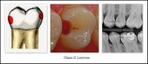 Class 2 caries in GV Black classification