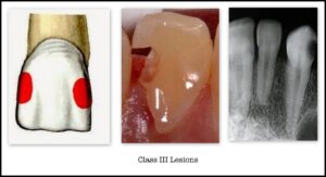 Class 3 caries in GV Black classification