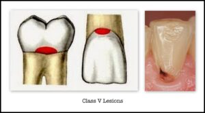Class 5 caries in GV Black classification