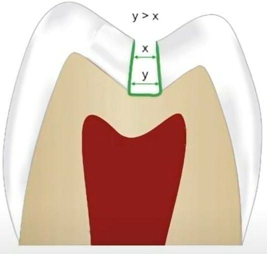 Convergent walls in cavity preparation.