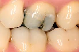 cracked teeth in treatment of traumatized teeth