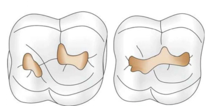 Cuspal distance in cavity preparation