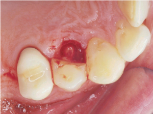 cuspal fracture in treatment of traumatised teeth