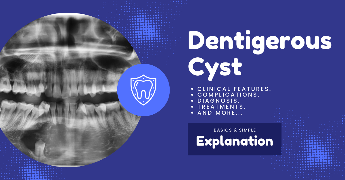 Dentigerous Cyst symptoms, causes, complications, treatments, and radiographs.