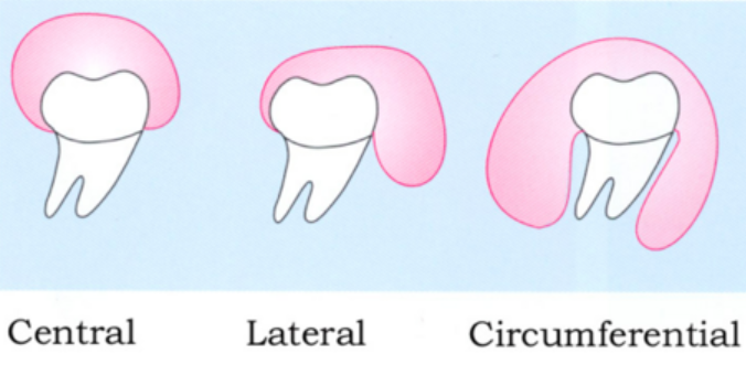 Dentigerous cyst variety. 