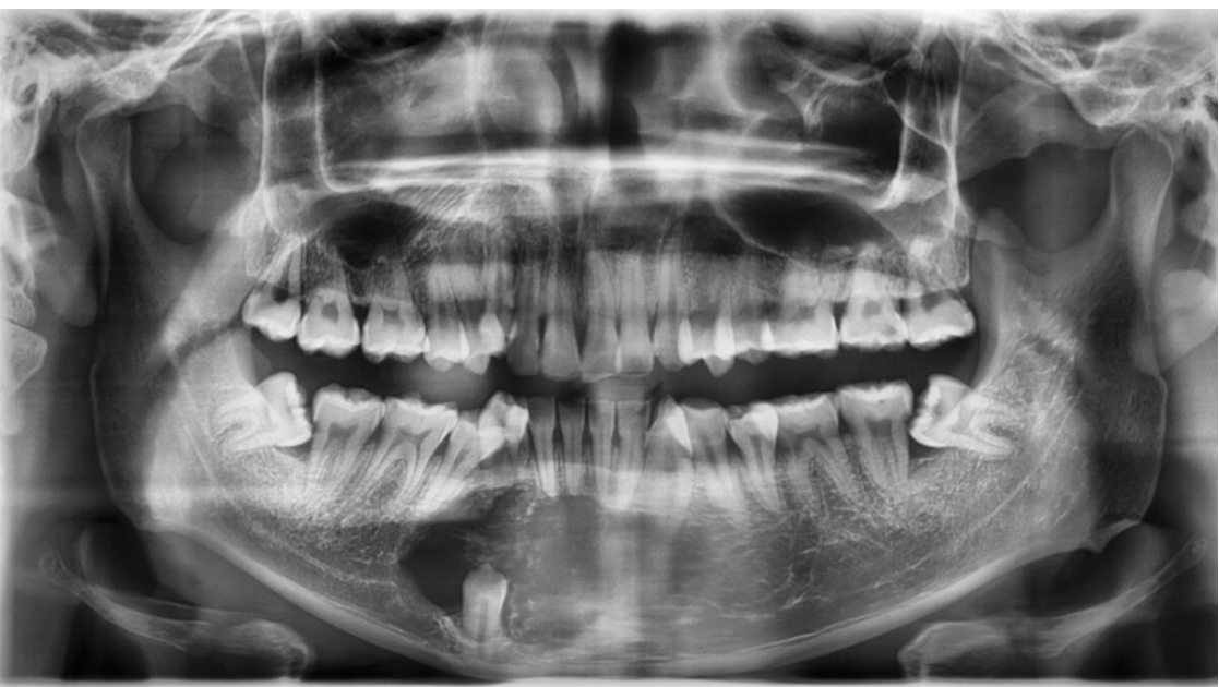 Dentigerous cyst.