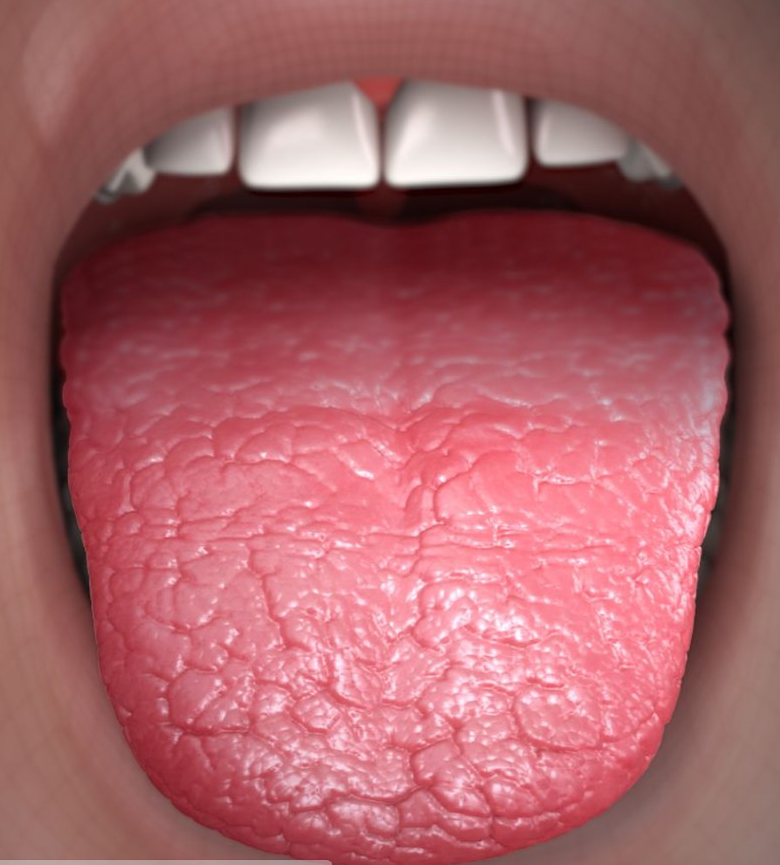 Dry mouth in angular cheilitis.