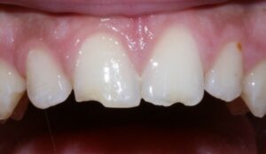enamel fracture in treatment of traumatised tooth