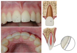 enamel infraction in tratment of truamatised tooth