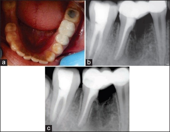 Endodontic Implants Image