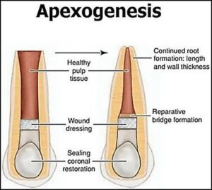 Apexogenesis in Endodontics