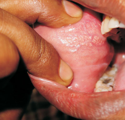 Fordyce granule in buccal mucosa. 
