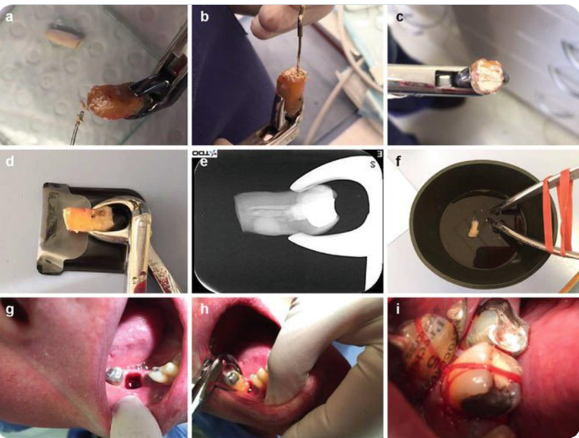 INTENSIONAL REPLANTATION in Endodontics