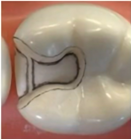 Occlusal dovetail in cavity preparation. 