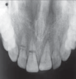 occlusal view in traumatised teeth 