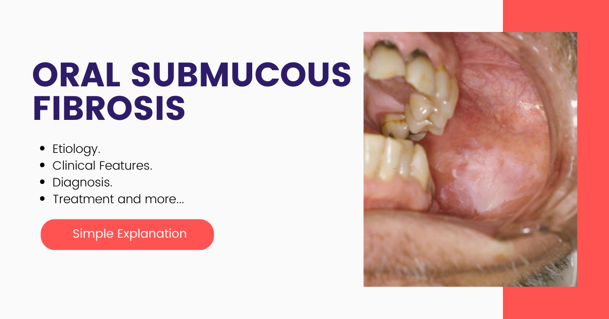 Oral Submucous Fibrosis complete details