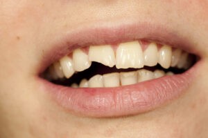 split tooth in treatment of traumatized teeth