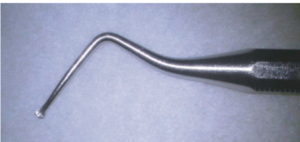 Endodontic spoon excavator used for access cavity preparation