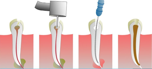 Steps in root canal treatment.
