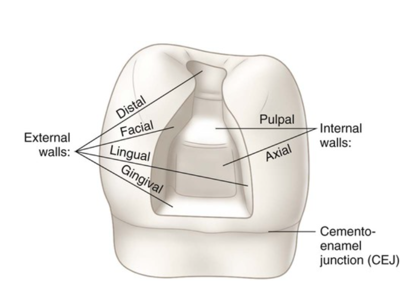 Walls in cavity preparation